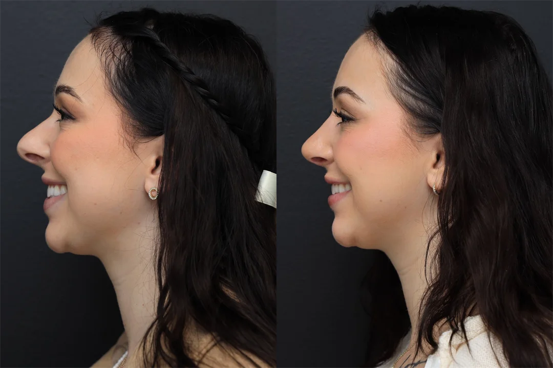 98509-Left Lateral – Smiling combined