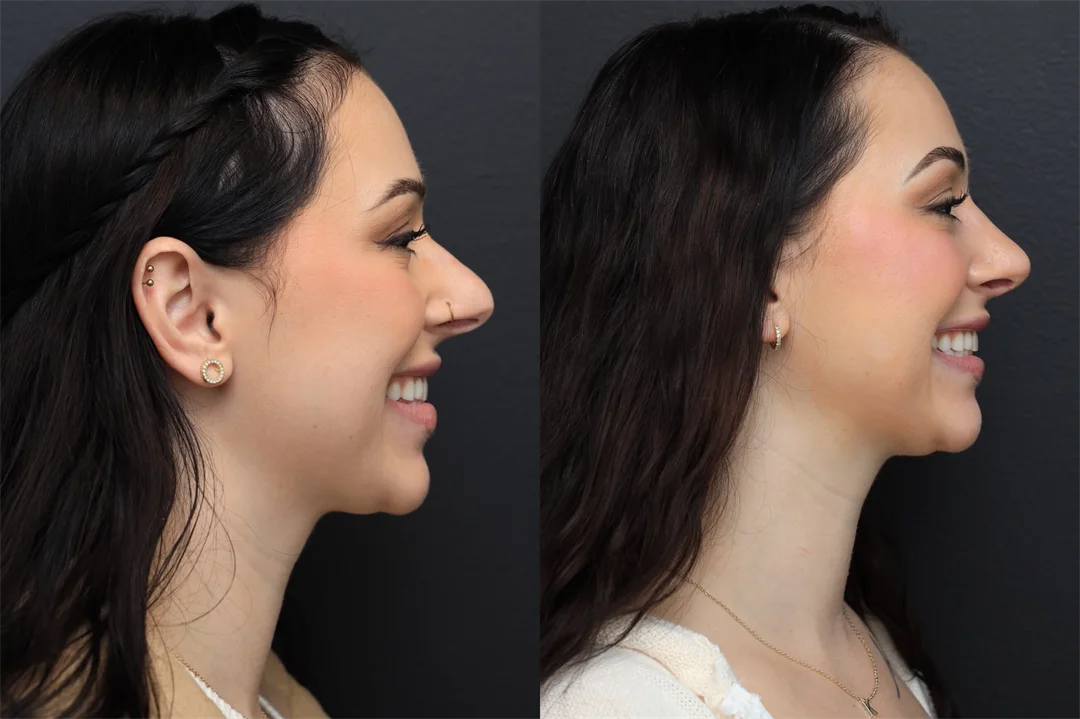 98509-Right Lateral – Smiling combined