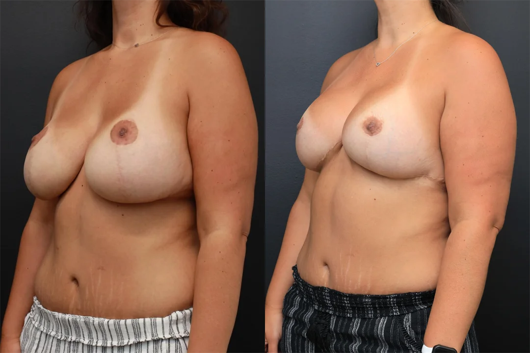 98510-Left Oblique combined
