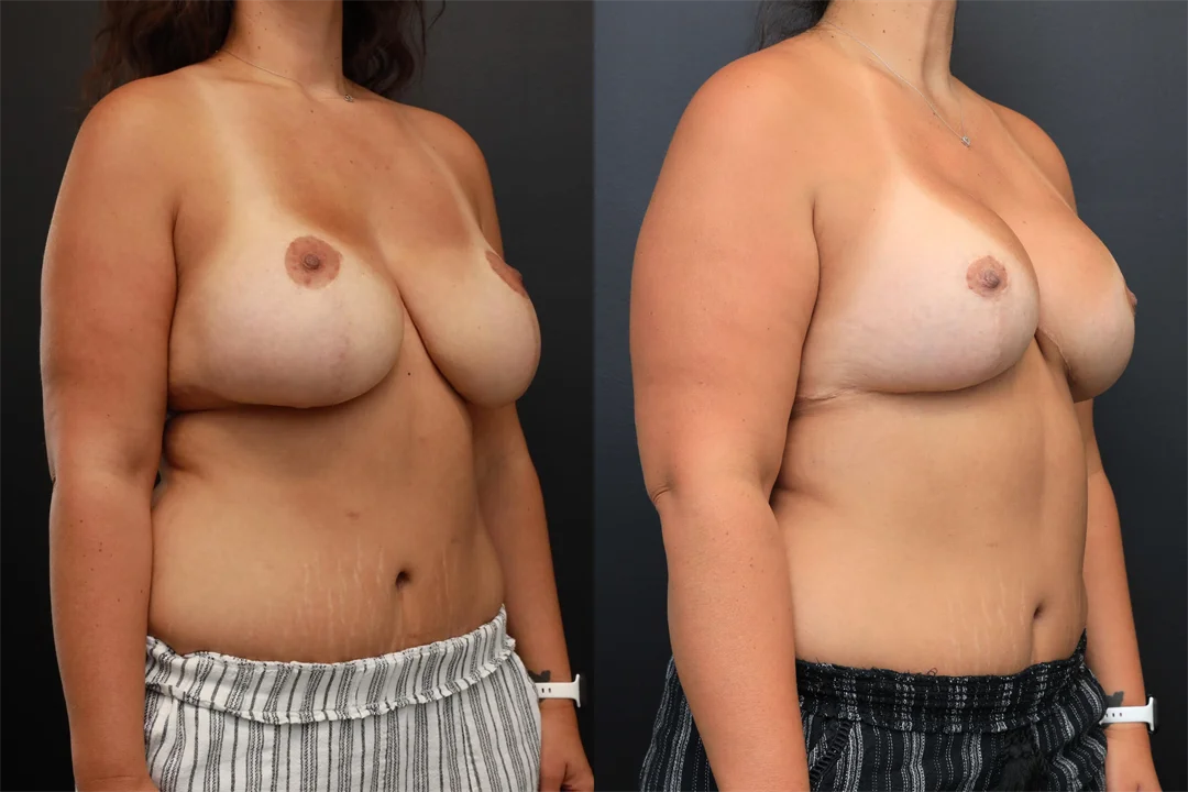 98510-Right Oblique combined