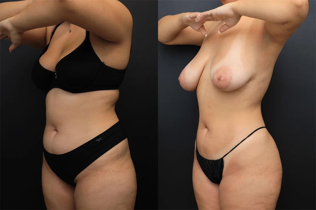 98695-Left Oblique combined