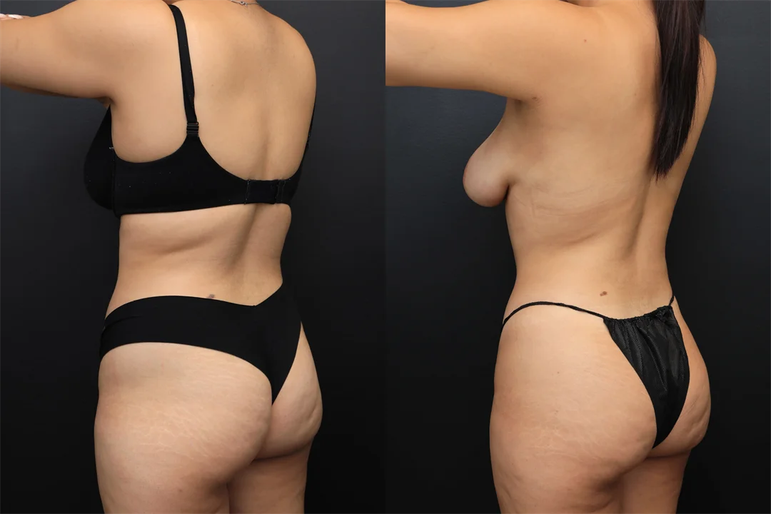 98695-Left Posterior Oblique combined