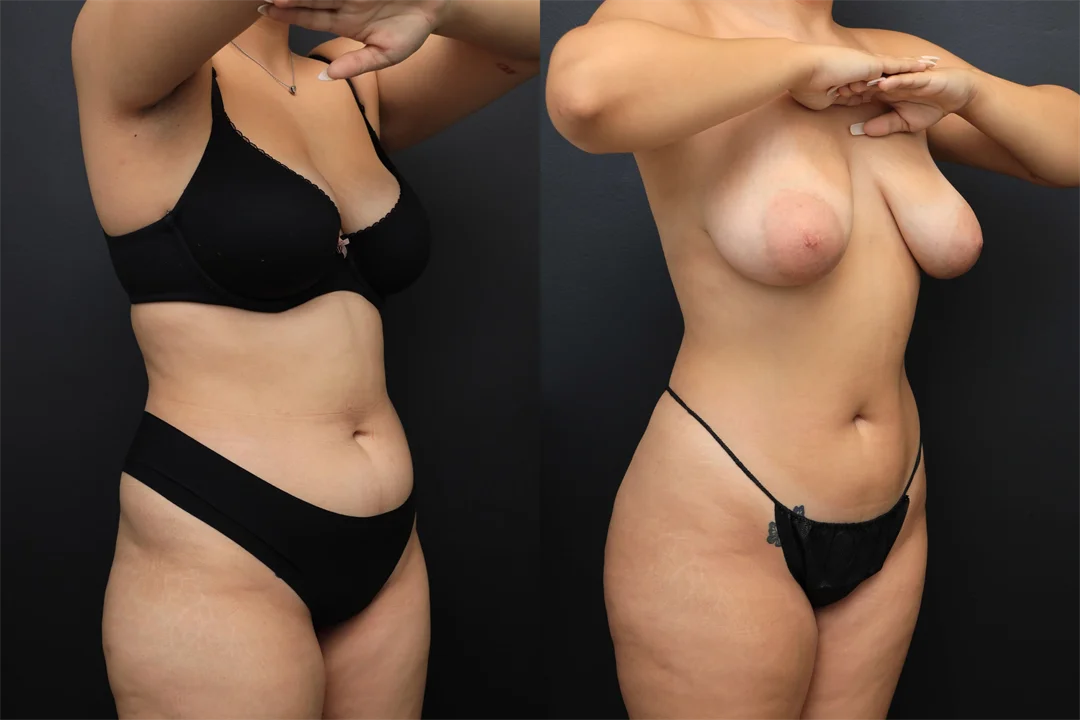 98695-Right Oblique combined