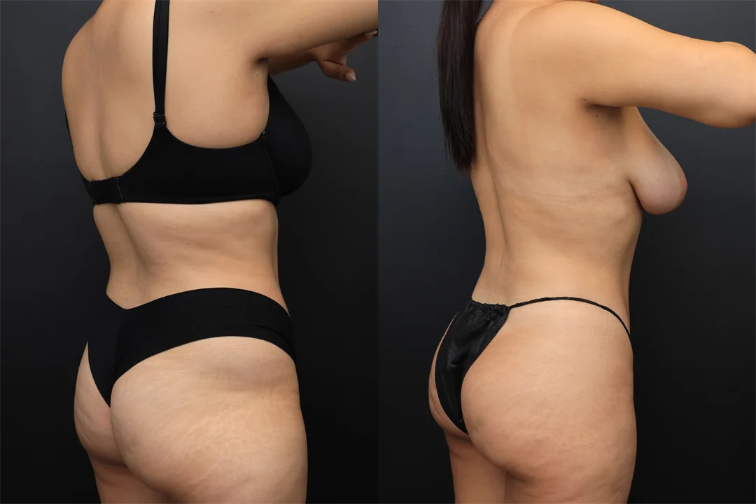 98695-Right Posterior Oblique combined