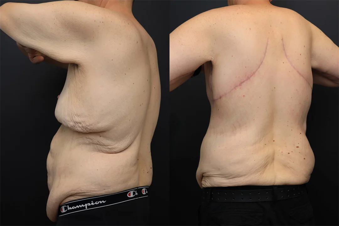 98700-Left Posterior Oblique combined