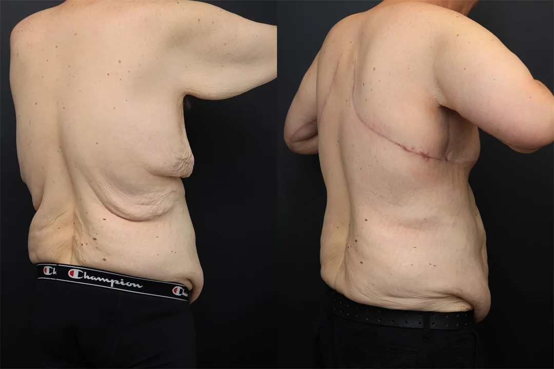 98700-Right Posterior Oblique combined