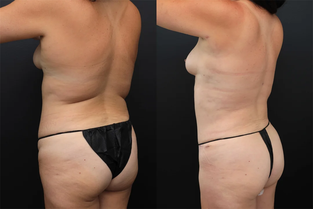 99032-Left Posterior Oblique combined