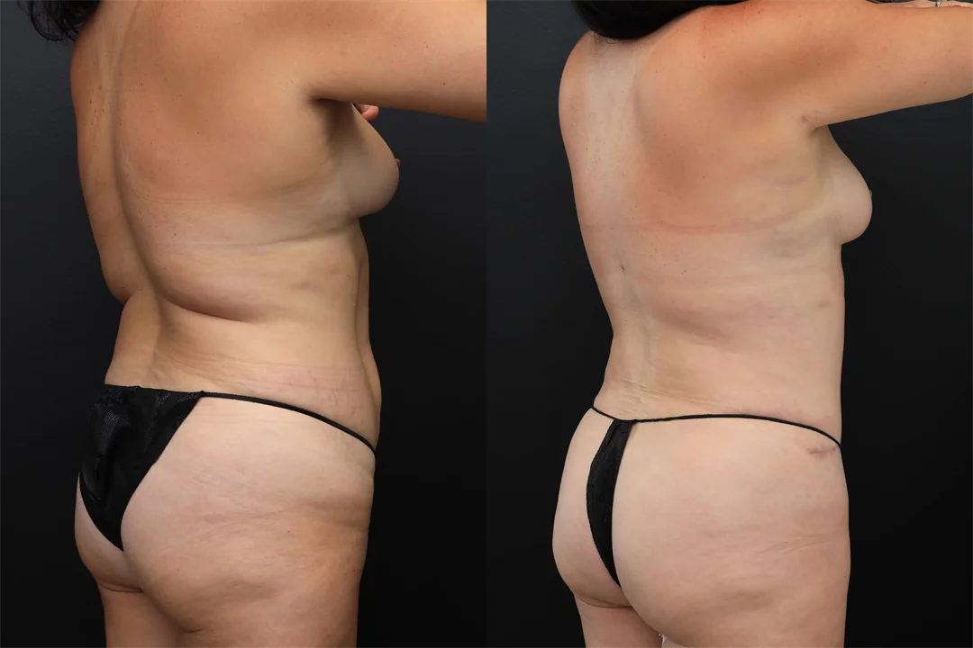 99032-Right Posterior Oblique combined