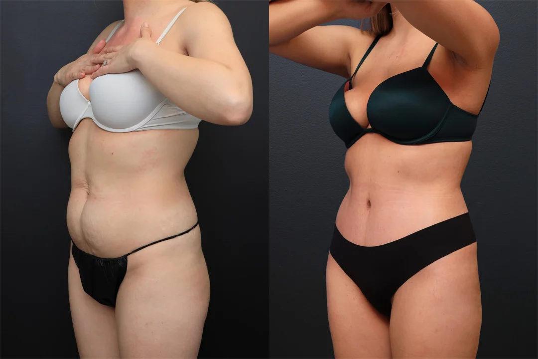 99929-Left Oblique combined