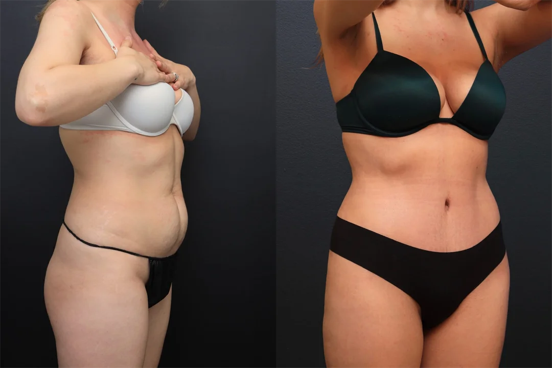 99929-Right Oblique combined