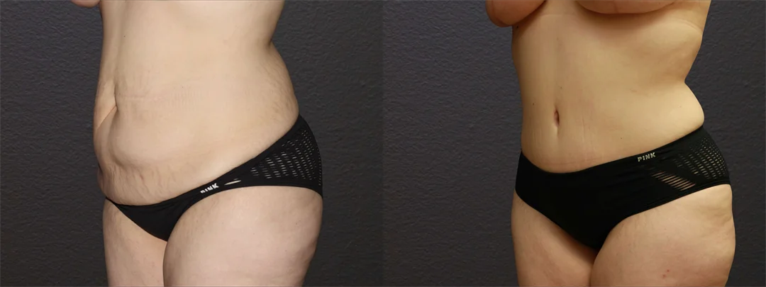 66814-LEFT OBLIQUE Before