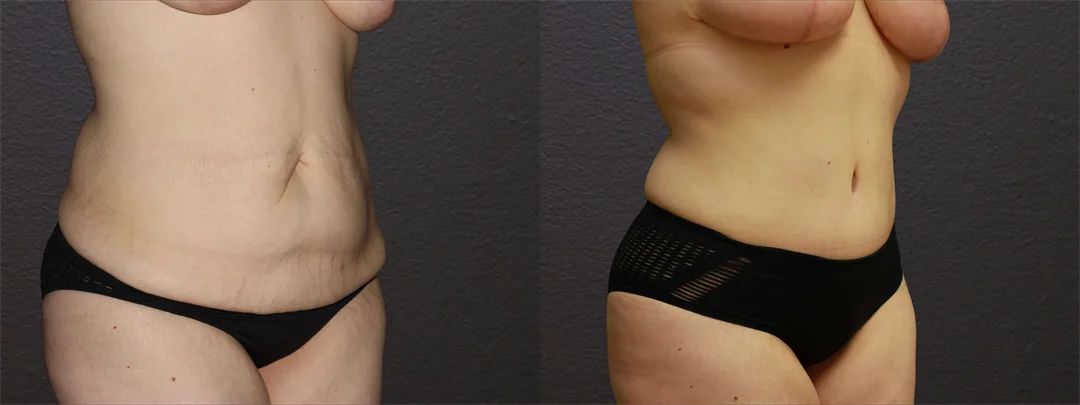 66814-RIGHT OBLIQUE Before